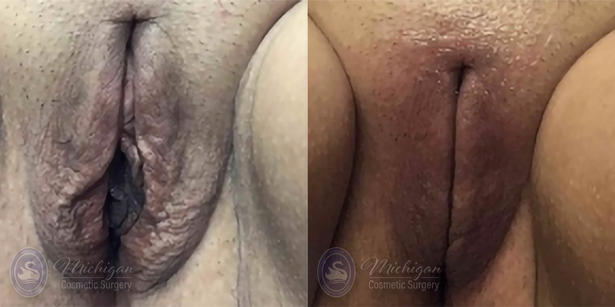 Labiaplasty Before and After Photo by Dr. Awada in Southfield Michigan