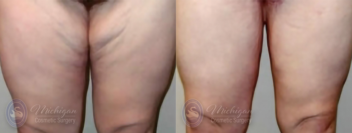 Thigh Lift in Detroit, MI  Michigan Cosmetic Surgery