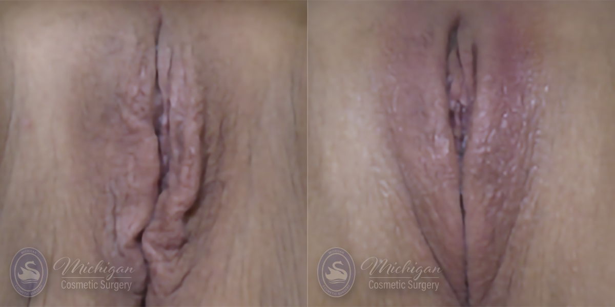 Labiaplasty Before and After Photo by Dr. Awada in Southfield Michigan