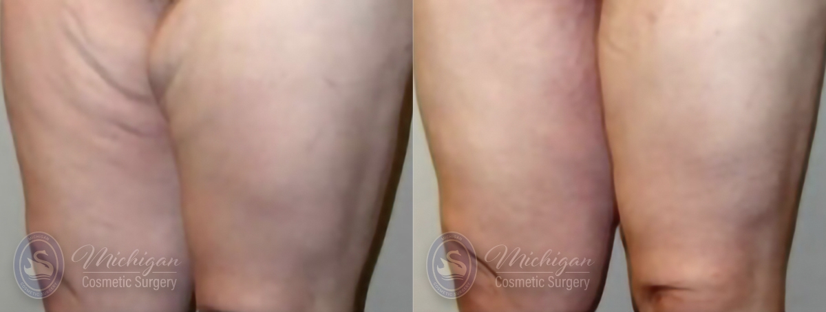 Thigh Lift Before and After Photo by Dr. Awada in Southfield Michigan