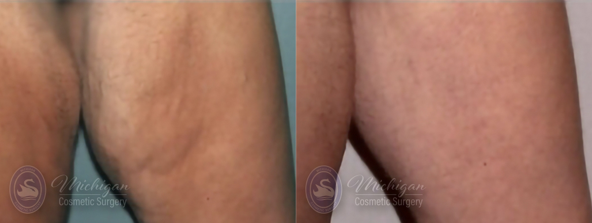 Thigh Lift Before and After Photo by Dr. Awada in Southfield Michigan