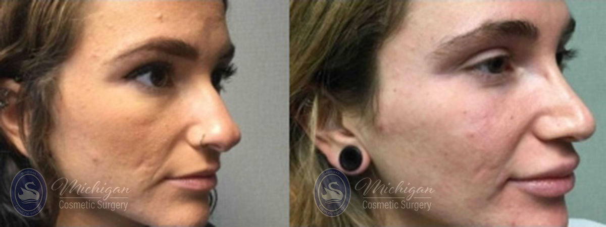 Rhinoplasty Before and After Photo by Dr. Awada in Southfield Michigan