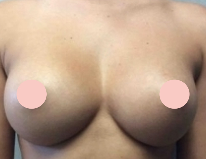 Breast Augmentation Before and After Photo by Dr. Awada in Southfield Michigan