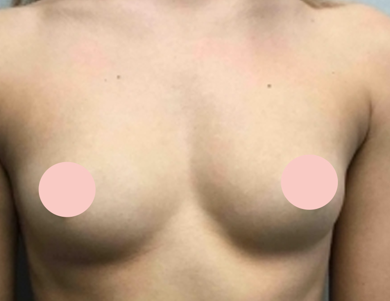 Breast Augmentation Before and After Photo by Dr. Awada in Southfield Michigan