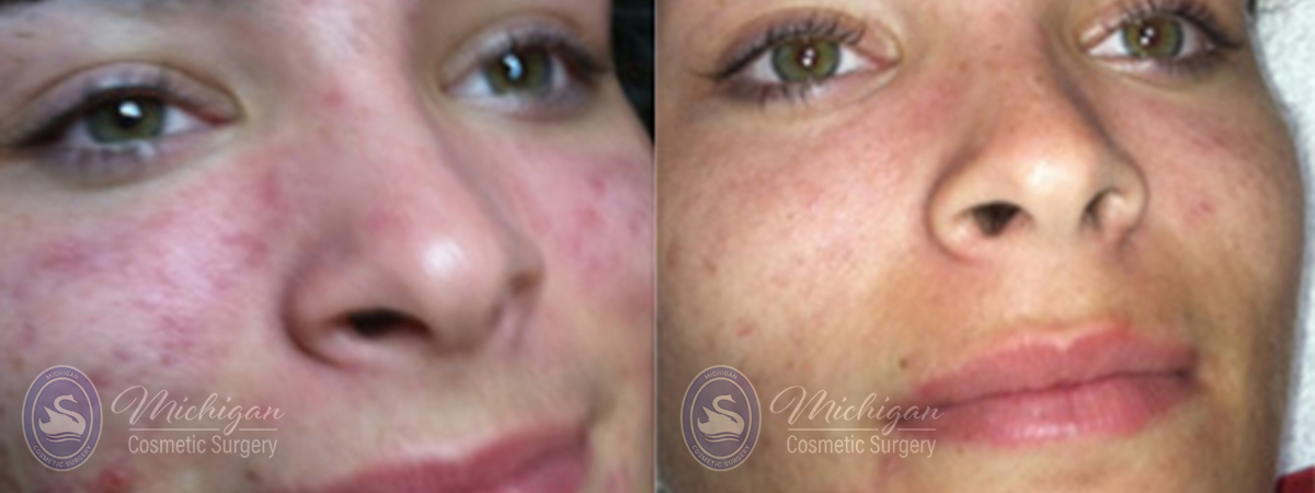 Acne Removal Before and After Photo by Dr. Awada in Southfield Michigan