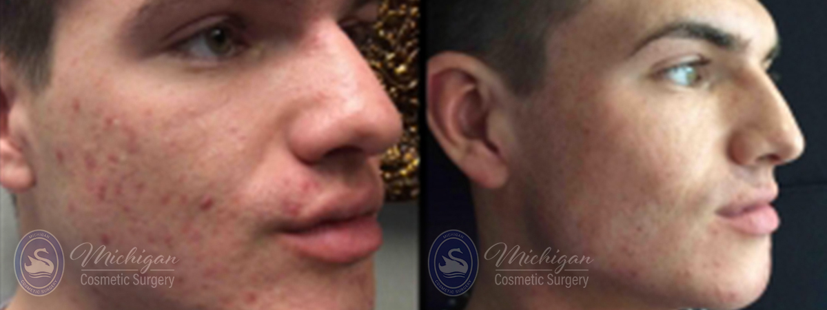 Acne Removal Before and After Photo by Dr. Awada in Southfield Michigan