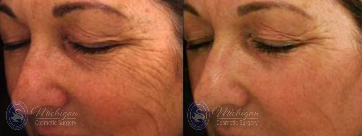 Anti-Aging Before and After Photo by Dr. Awada in Southfield Michigan