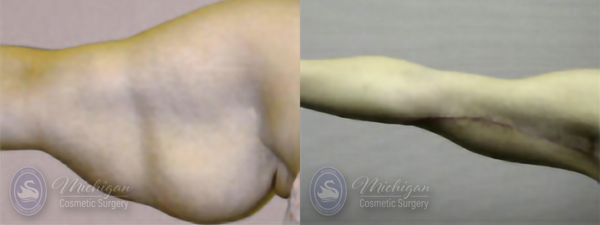 Arm Lift Before and After Photo by Dr. Awada in Southfield Michigan