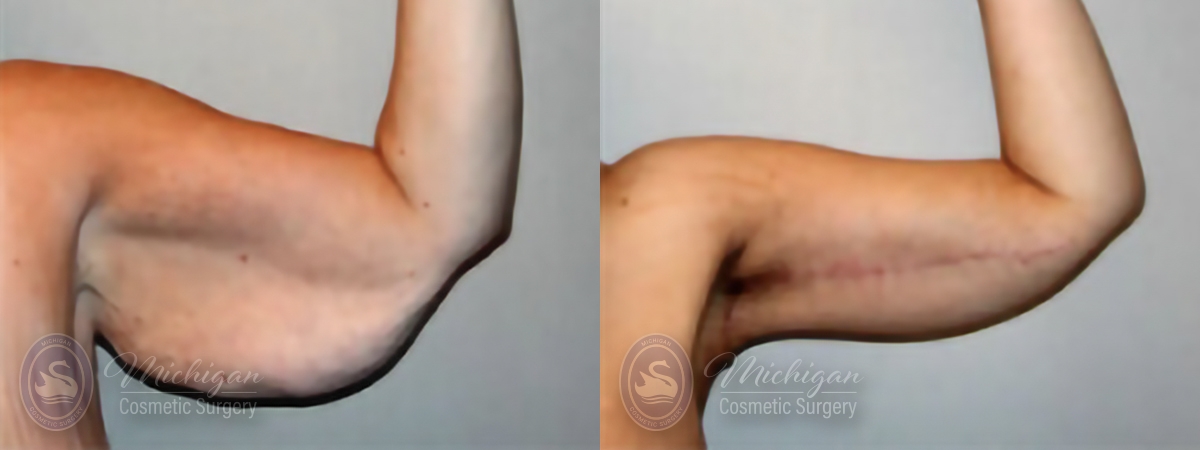 Arm Lift Before and After Photo by Dr. Awada in Southfield Michigan