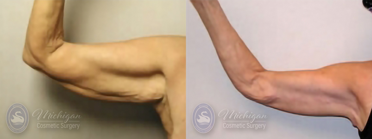 Arm Lift Before and After Photo by Dr. Awada in Southfield Michigan