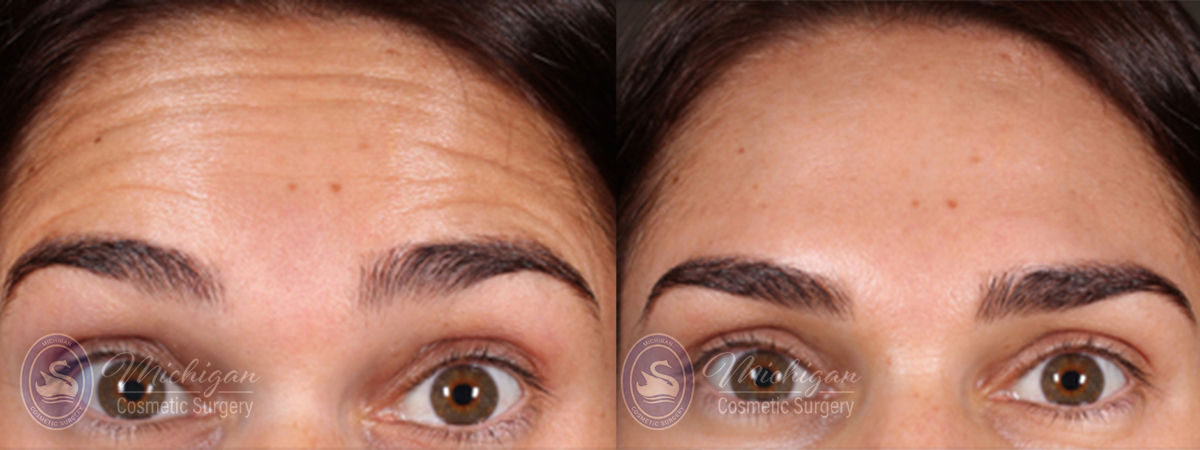 Botox Before and After Photo by Dr. Awada in Southfield Michigan