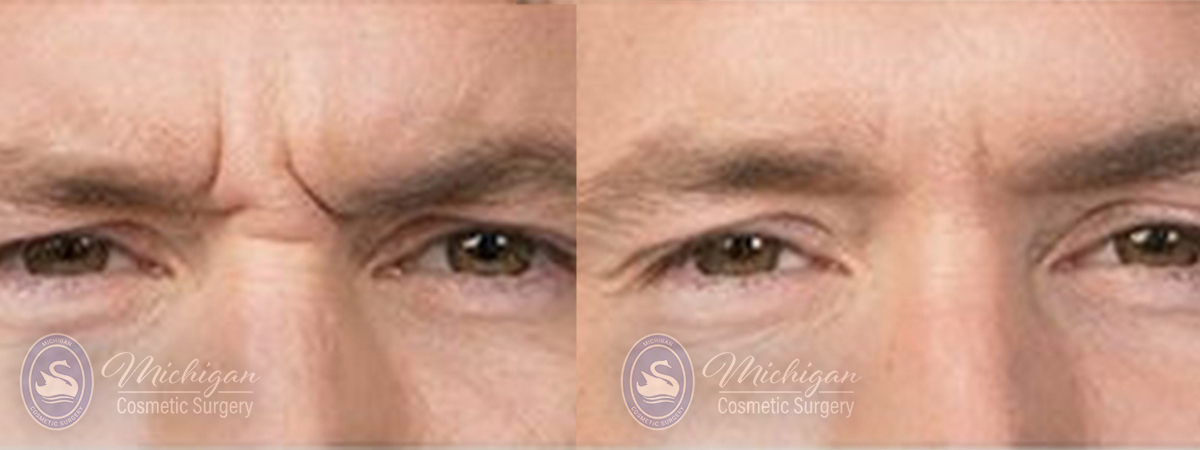 Botox Before and After Photo by Dr. Awada in Southfield Michigan