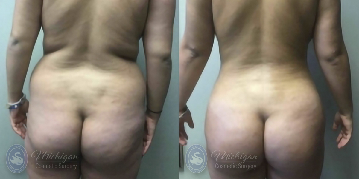 Brazilian Butt Lift Before and After Photo by Dr. Awada in Southfield Michigan