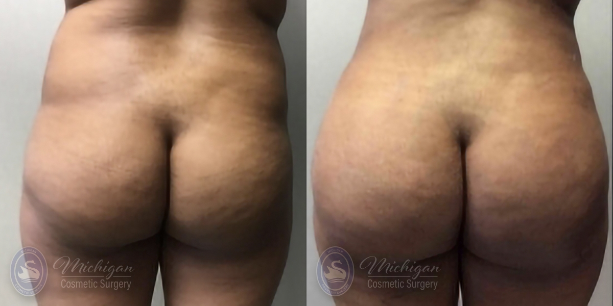 Brazilian Butt Lift Before and After Photo by Dr. Awada in Southfield Michigan