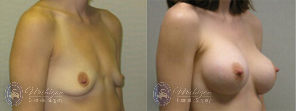 Breast Asymmetry Before and After Photo by Dr. Awada in Southfield Michigan