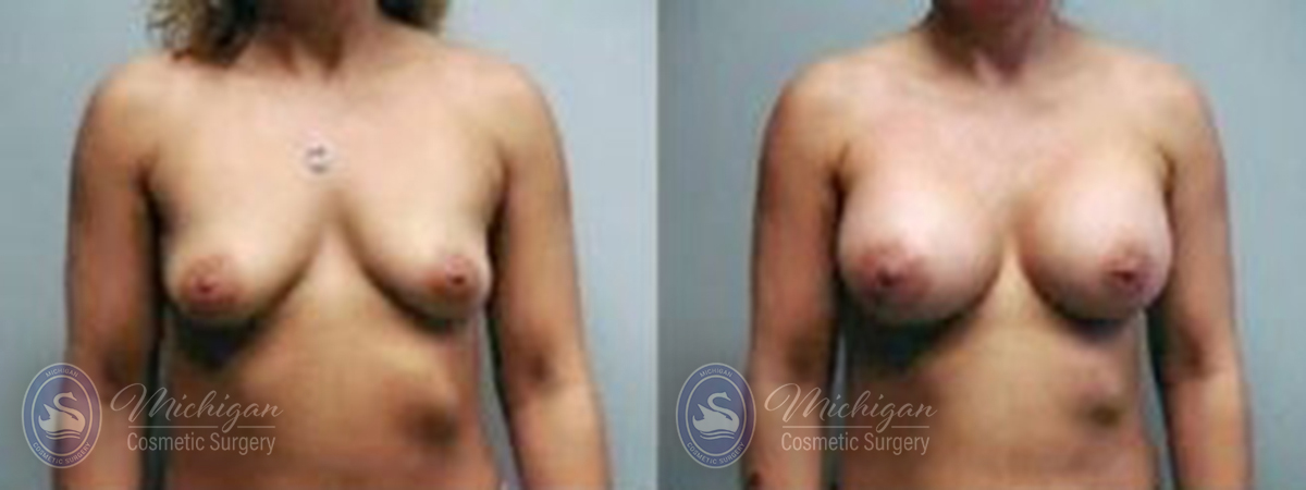 Breast Asymmetry Before and After Photo by Dr. Awada in Southfield Michigan