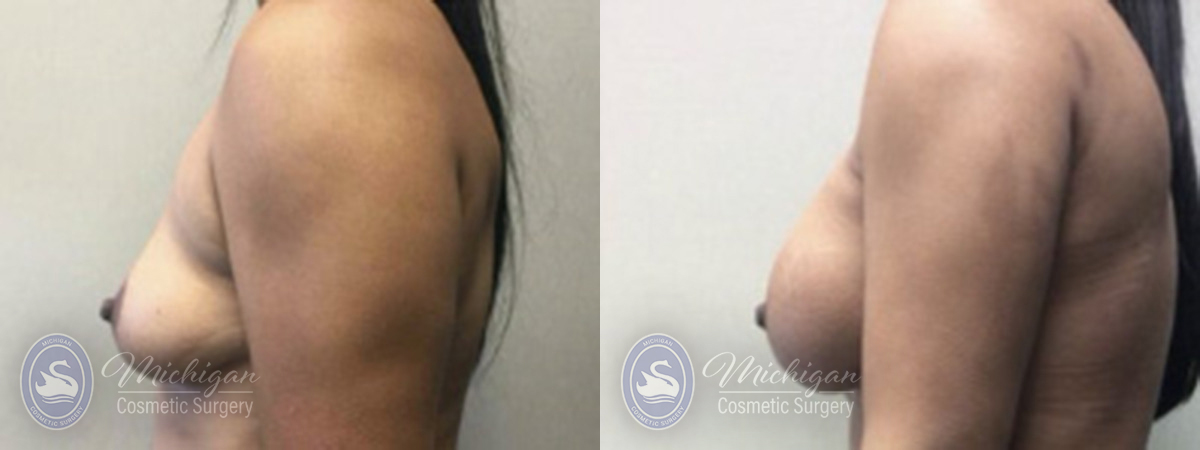 Breast Augmentation with Medium Lift Before and After Photo by Dr. Awada in Southfield Michigan
