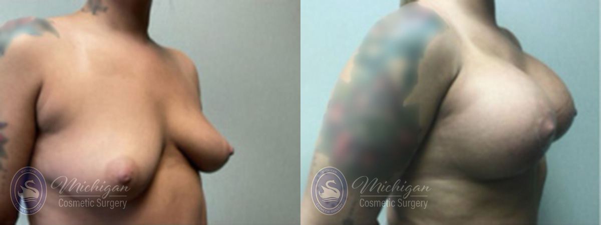 Breast Augmentation with Medium Lift Before and After Photo by Dr. Awada in Southfield Michigan
