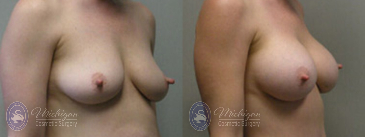 Breast Augmentation with Small Lift Before and After Photo by Dr. Awada in Southfield Michigan