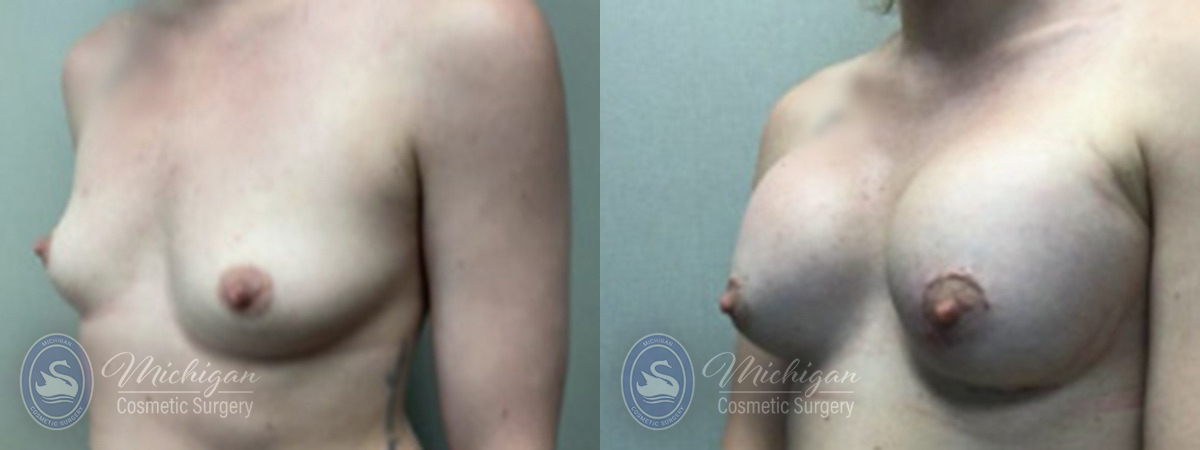 Breast Augmentation with Small Lift Before and After Photo by Dr. Awada in Southfield Michigan