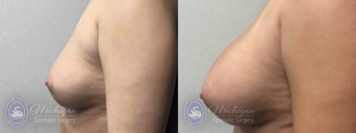 Breast Augmentation Before and After Photo by Dr. Awada in Southfield Michigan
