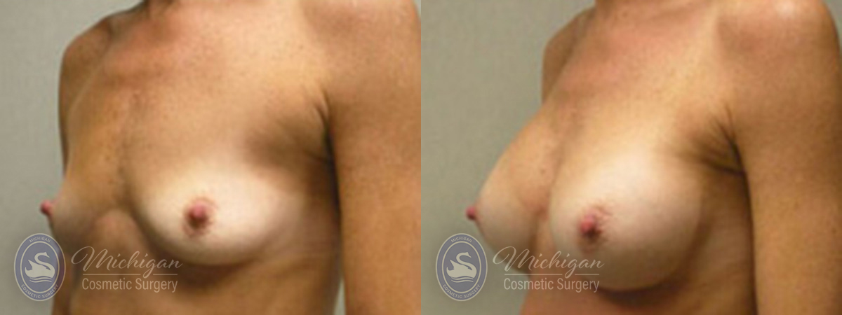 Breast Augmentation Before and After Photo by Dr. Awada in Southfield Michigan