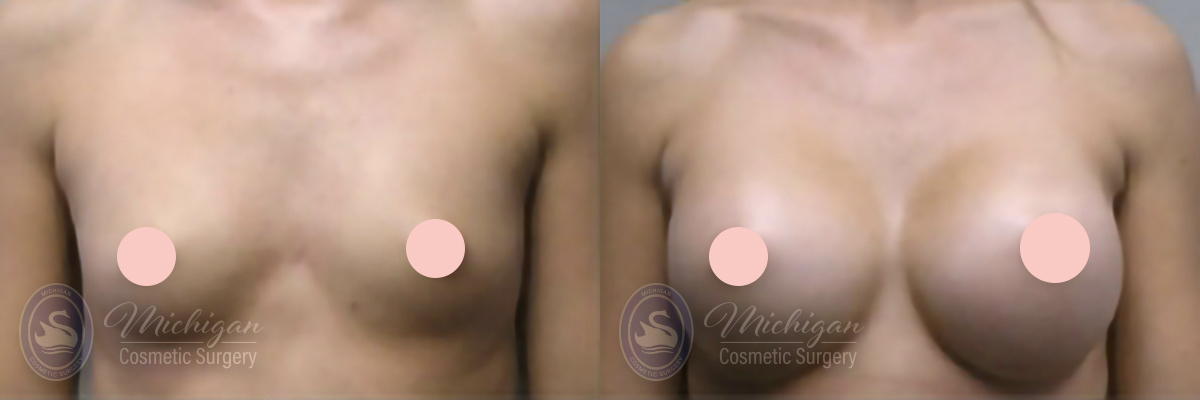 Breast Augmentation Before and After Photo by Dr. Awada in Southfield Michigan