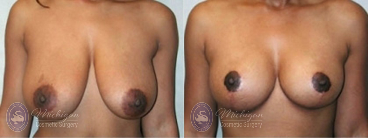 Breast Lift Before and After Photo by Dr. Awada in Southfield Michigan