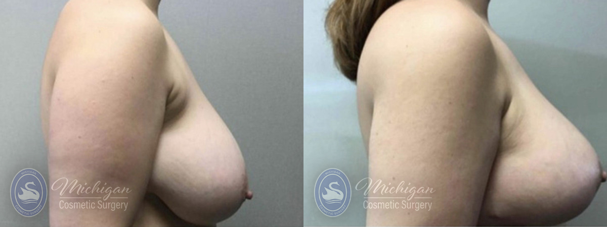 Breast Lift Before and After Photo by Dr. Awada in Southfield Michigan