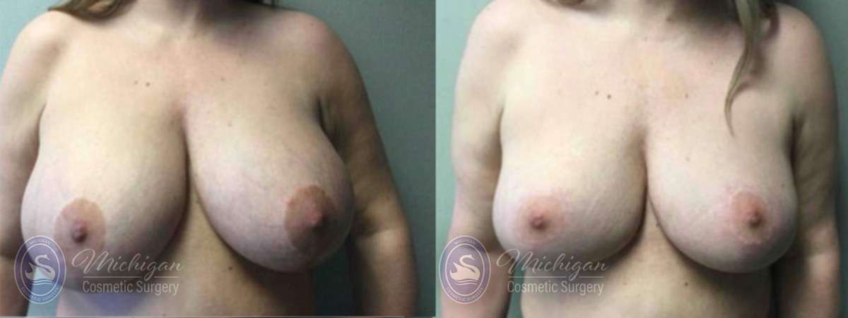 Breast Reduction Before and After Photo by Dr. Awada in Southfield Michigan