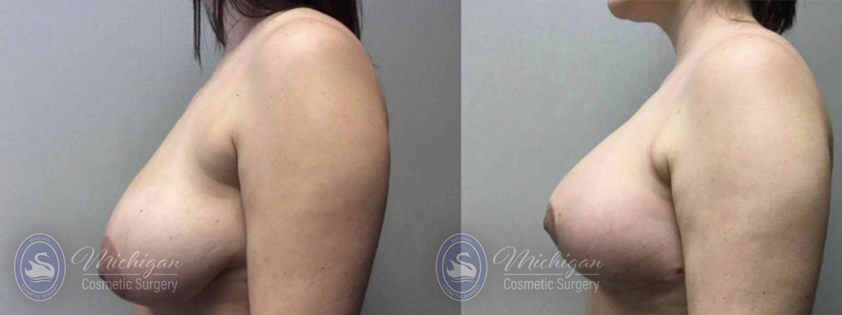 Breast Reduction Before and After Photo by Dr. Awada in Southfield Michigan