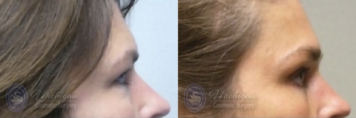 Brow Lift Before and After Photo by Dr. Awada in Southfield Michigan