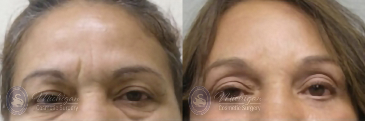 Brow Lift Before and After Photo by Dr. Awada in Southfield Michigan