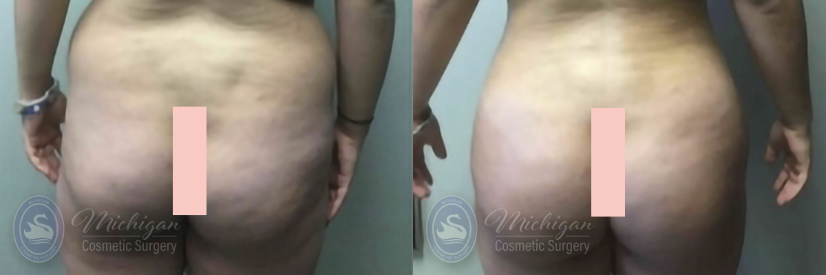 Brazilian Butt Lift Before and After Photo by Dr. Awada in Southfield Michigan