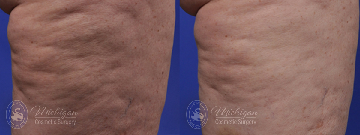 Cellulite Treatment Before and After Photo by Dr. Awada in Southfield Michigan