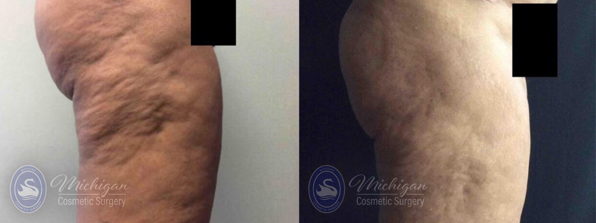 Cellulite Treatment Before and After Photo by Dr. Awada in Southfield Michigan