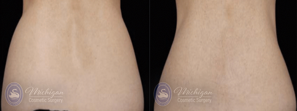 CoolSculpting Before and After Photo by Dr. Awada in Southfield Michigan