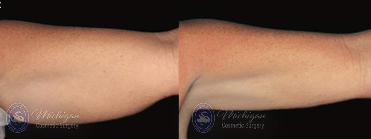 CoolSculpting Before and After Photo by Dr. Awada in Southfield Michigan