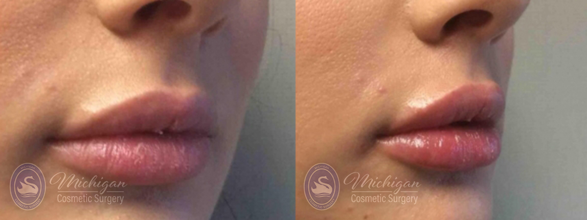 Dermal Fillers Before and After Photo by Dr. Awada in Southfield Michigan