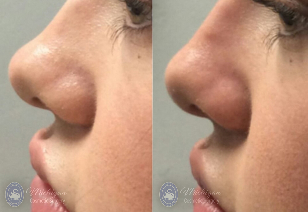 Dermal Fillers Before and After Photo by Dr. Awada in Southfield Michigan