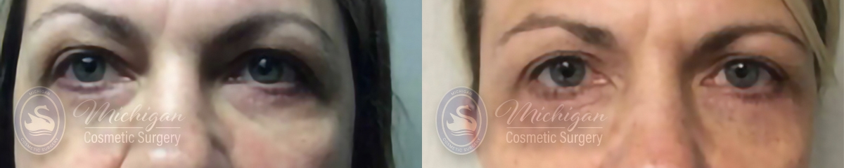 Eyelid Surgery Before and After Photo by Dr. Awada in Southfield Michigan