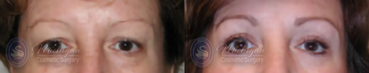 Eyelid Surgery Before and After Photo by Dr. Awada in Southfield Michigan