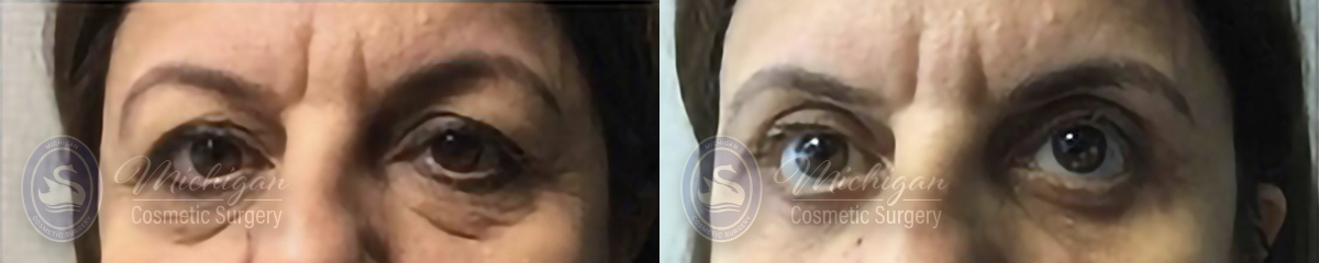 Eyelid Lift Before and After Photo by Dr. Awada in Southfield Michigan