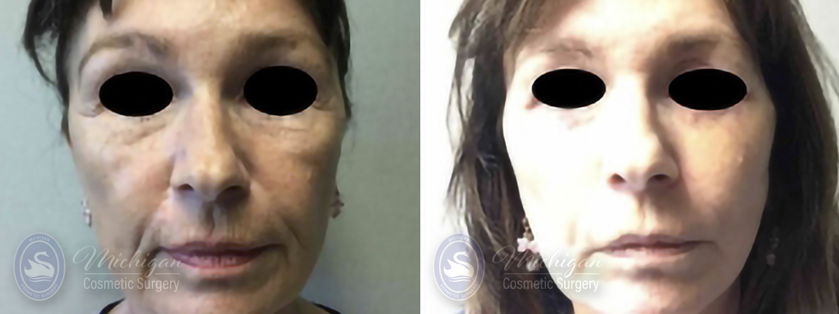 Facelift/Necklift Before and After Photo by Dr. Awada in Southfield Michigan