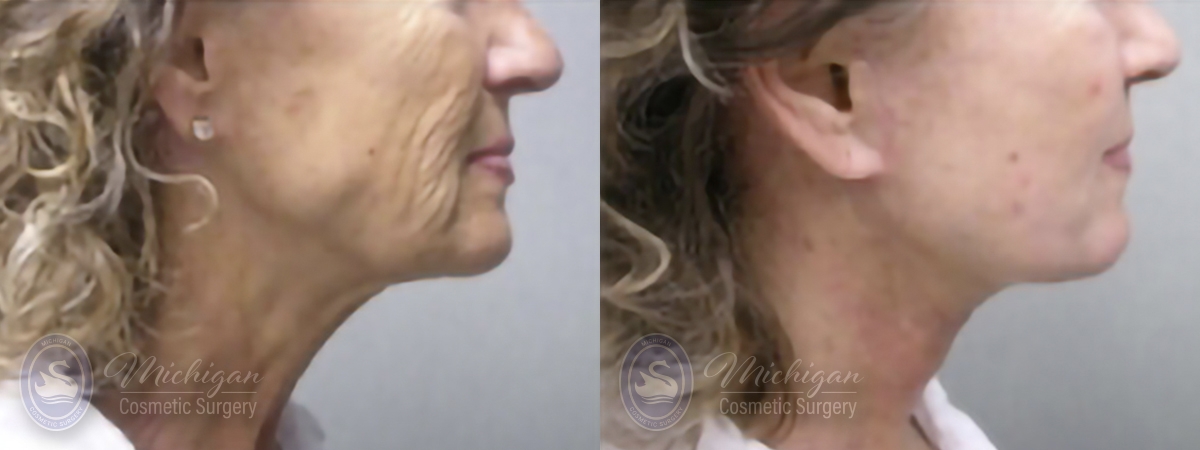 Facelift/Neck Lift Before and After Photo by Dr. Awada in Southfield Michigan