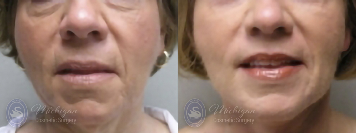 Facelift/Necklift Before and After Photo by Dr. Awada in Southfield Michigan