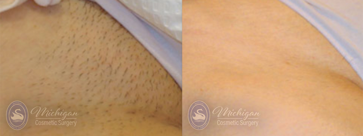 Laser Hair Removal Before and After Photo by Dr. Awada in Southfield Michigan