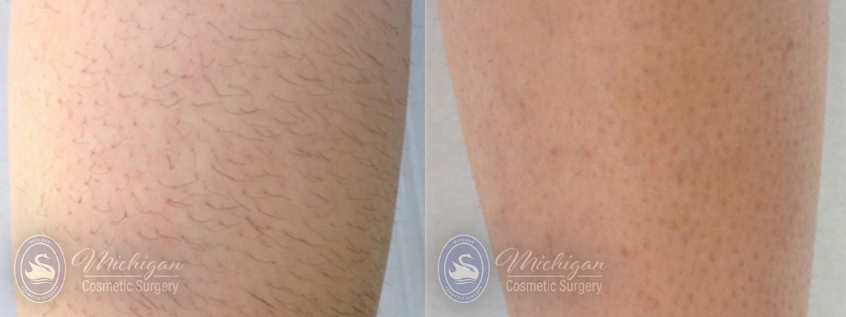 Laser Hair Removal Before and After Photo by Dr. Awada in Southfield Michigan