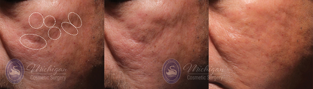 Laser Scar Removal Before and After Photo by Dr. Awada in Southfield Michigan