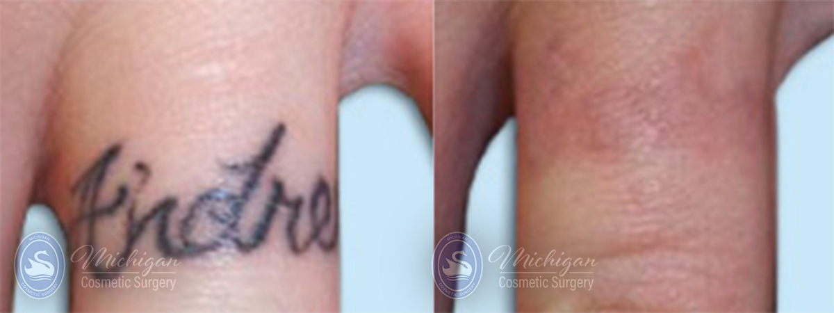 Laser Tattoo Removal Before and After Photo by Dr. Awada in Southfield Michigan